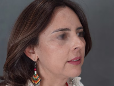 Resultado natural de blefaroplastia Dr. Andrés Parra