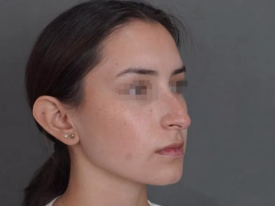 Estado antes - Rinoplastia Natural - Caso María