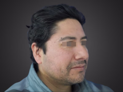Estado antes - Armonización Facial - Caso Laura