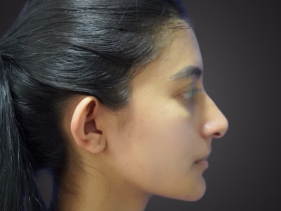 Estado antes - Armonización Facial Completa