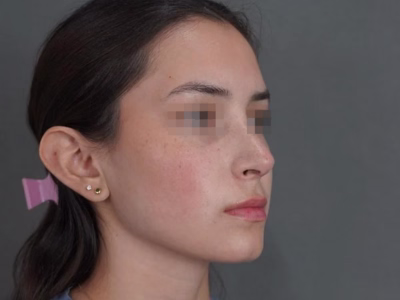 Resultado después - Rinoplastia Natural - Caso María