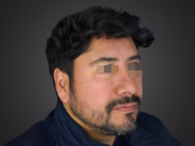 Resultado después - Armonización Facial - Caso Laura