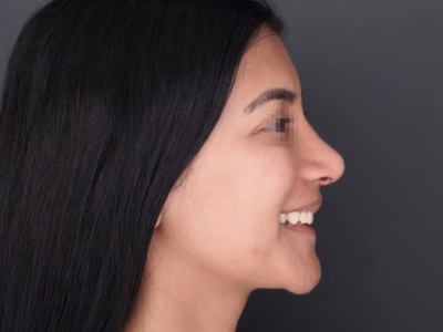 Resultado después - Armonización Facial Completa