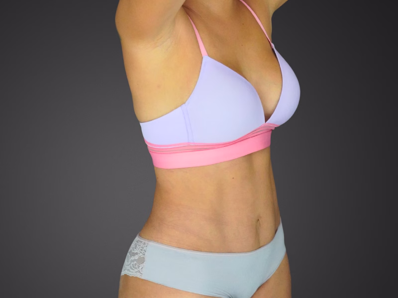 Resultado natural de abdominoplastia Dr. Andrés Parra