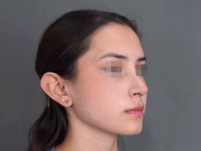 Resultados naturales de rinoplastia realizada por Dr. Andrés Parra