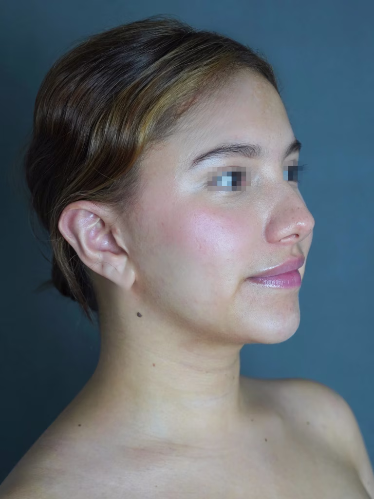 Resultado natural de rinoplastia ultrasónica realizada por Dr. Andrés Parra en Bogotá
